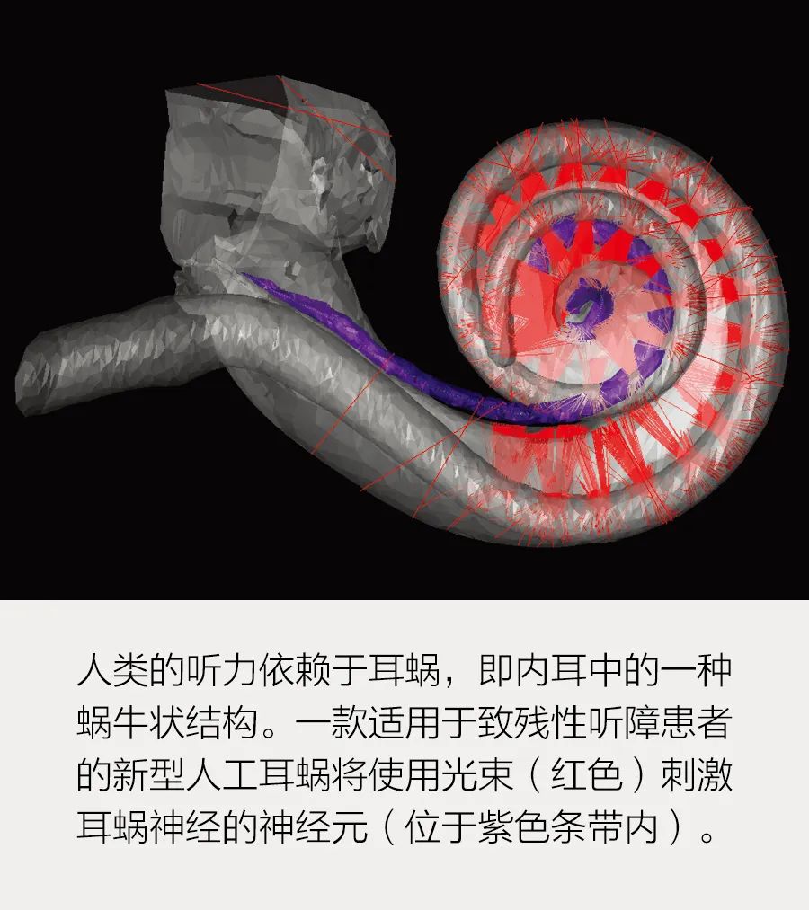 借助光束恢复听力