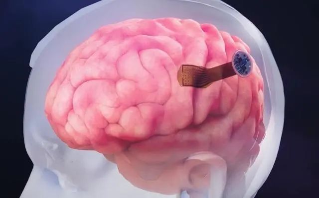 脑机接口最新科研进展，以“半侵入性”方式植入大脑！