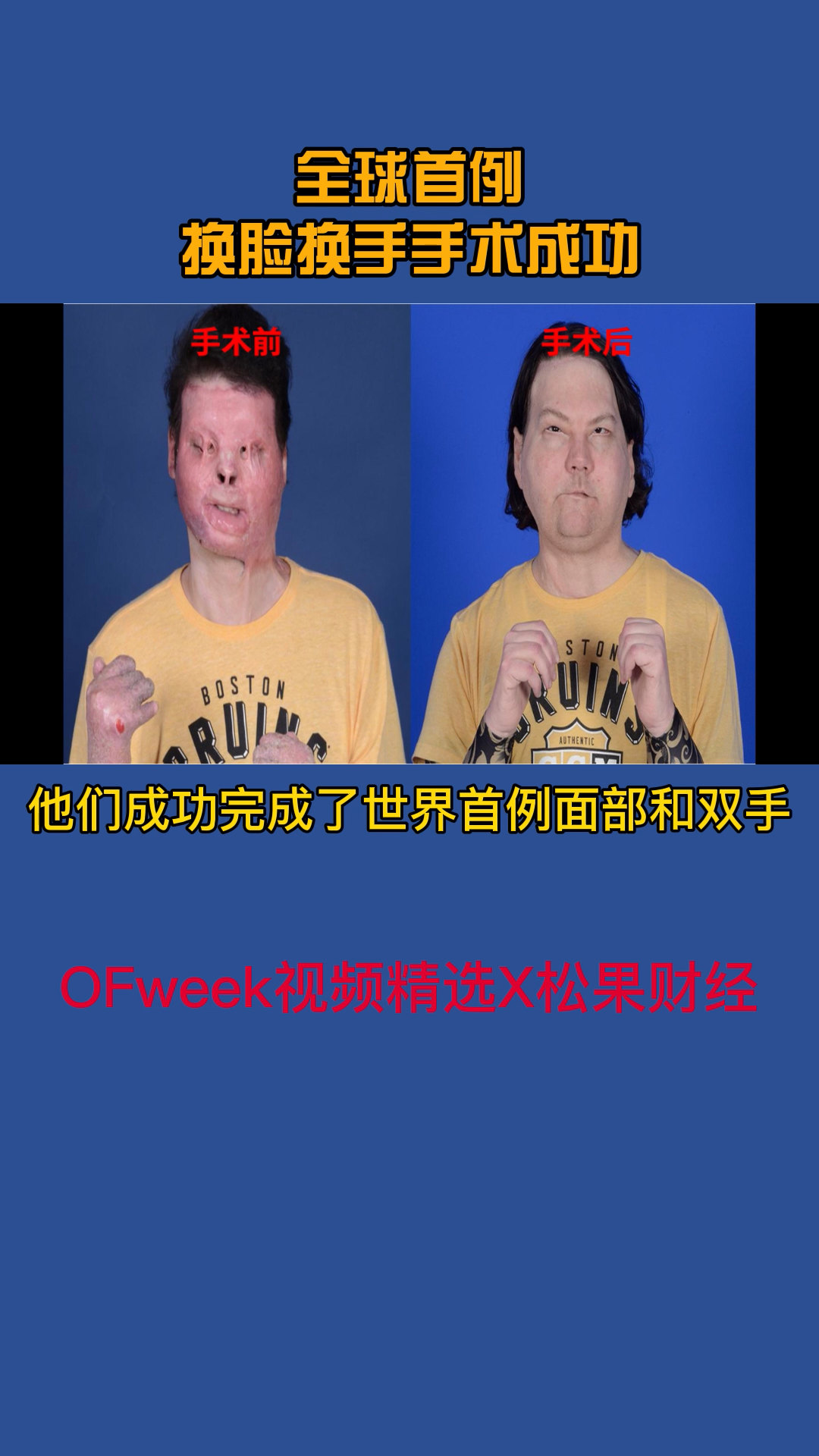 23小时、16名外科医生、6个医疗队，80名工作人员，全球首例换脸换手手术成功全球首例成功换脸换手手术